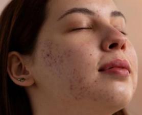 Tratamento Cicatriz De Acne Mauá