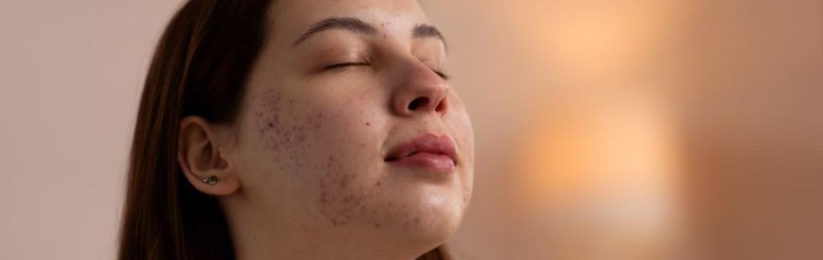Tratamento Cicatriz De Acne Mauá