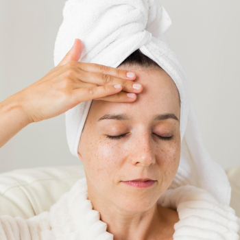 Tratamento Melasma